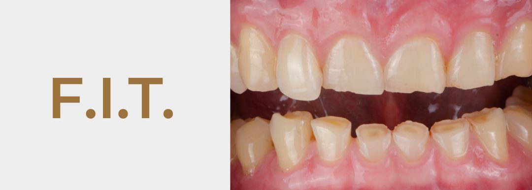 Renew a Smile: Gentle & effective tooth wear treatment with Forma® Injection Technique
