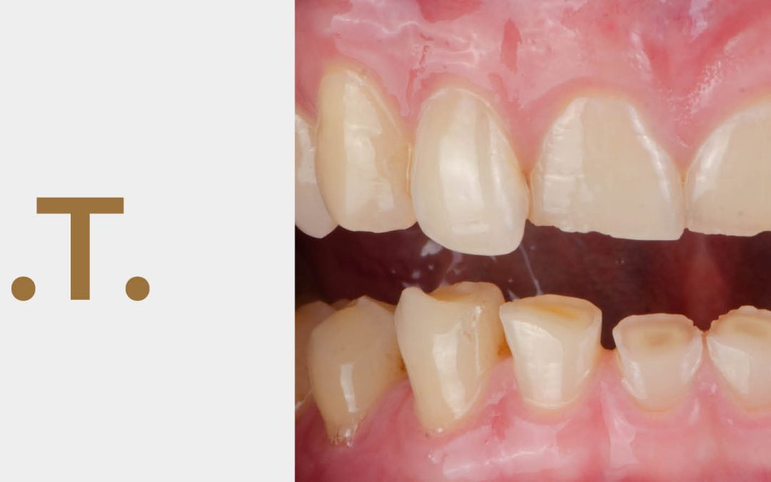 Renew a Smile: Gentle & effective tooth wear treatment with Forma® Injection Technique