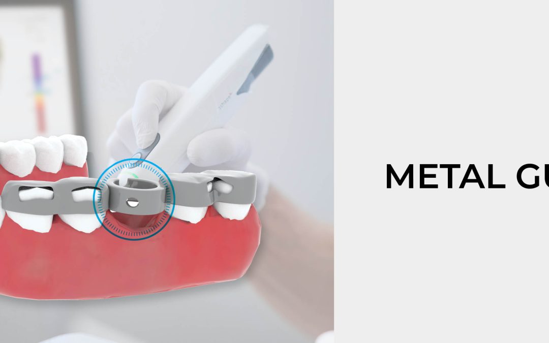 A more ease approach restoring smiles with implants