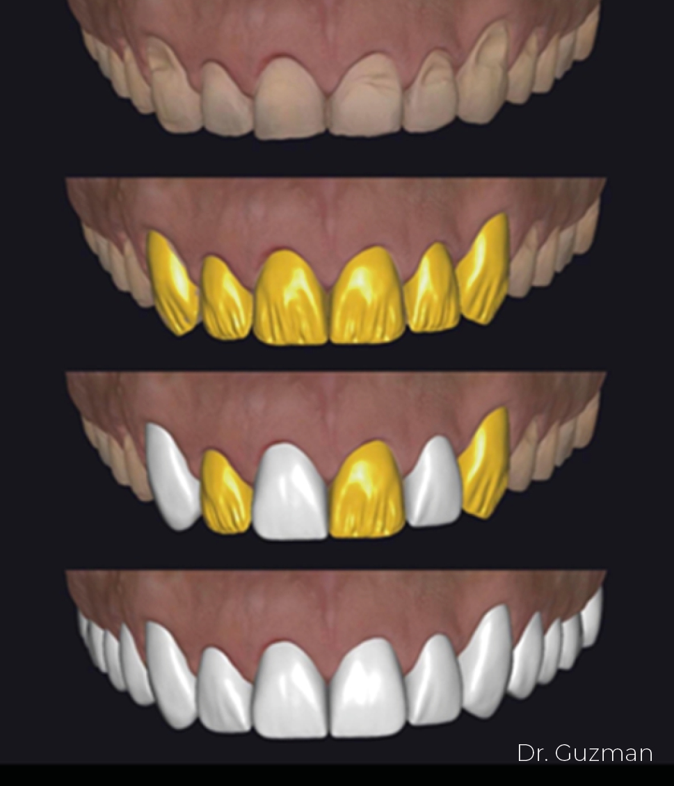 fit veneer