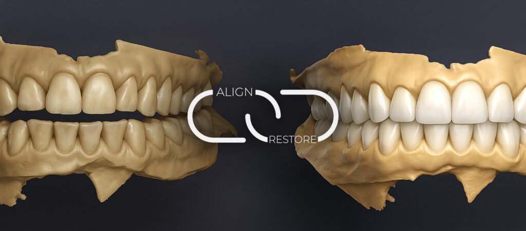 Mid Week Alignment What is the benefit of Pre-Restorative Alignment in Minimally Invasive ...