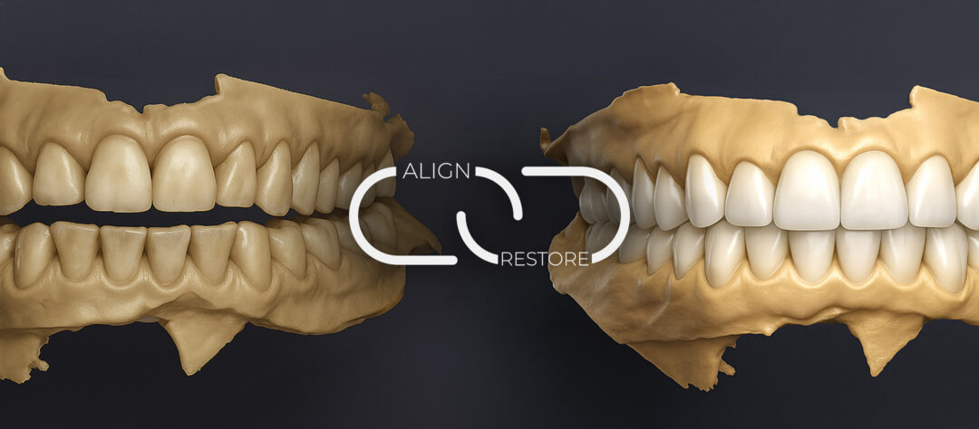 What is the benefit of Pre-Restorative Alignment in Minimally Invasive Dentistry (MID)?