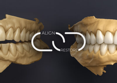 What is the benefit of Pre-Restorative Alignment in Minimally Invasive Dentistry (MID)?